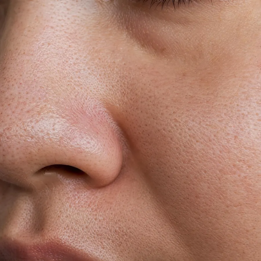 Texture de peau Pores dilatés